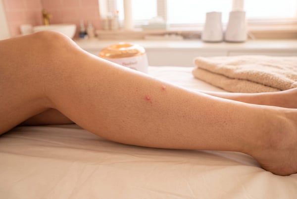 An illustration of an ingrown hair bump on a shin, on the treatment bed in the NU Beauty waxing room in Haverhill