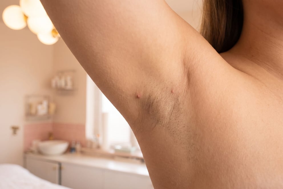 An illustration of an ingrown hair bump under the arm, on the treatment bed in the NU Beauty waxing room in Haverhill